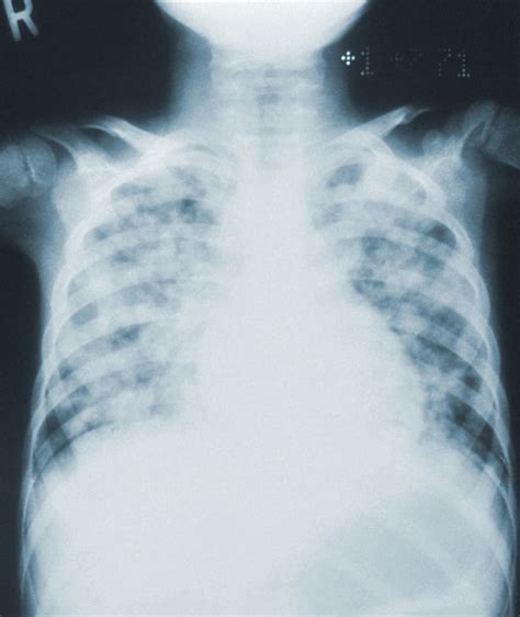 raio x com pneumonia-1